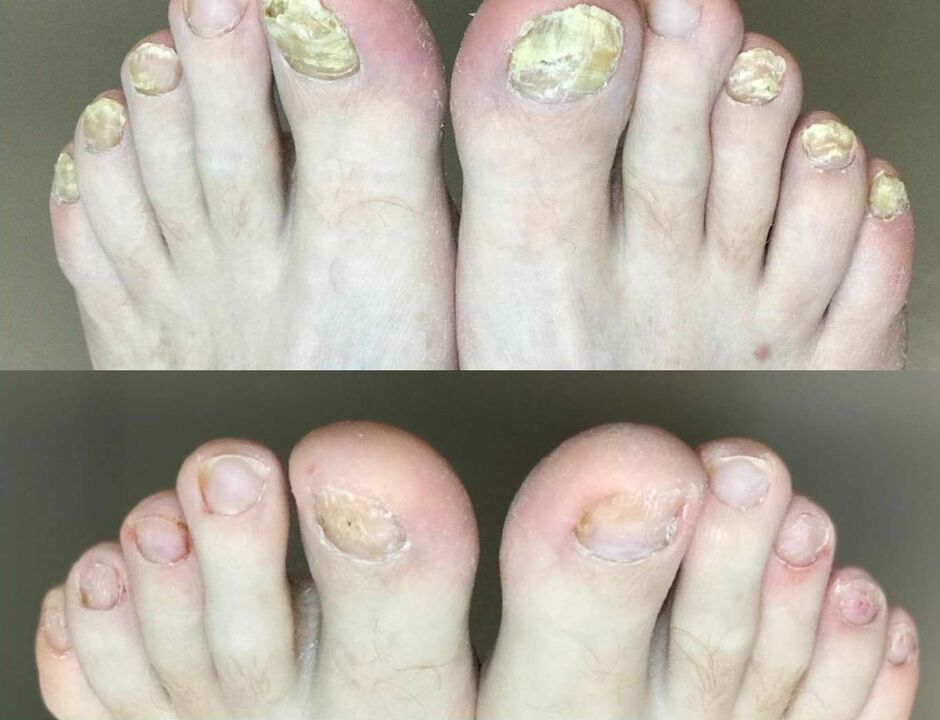 Before and after treatment is the fungus Promisil cream