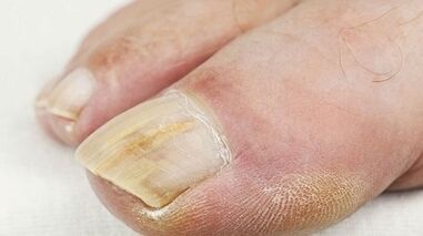 Causes of fungal appearance on the thumb of the foot
