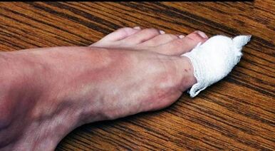 Compression to treat the fungus on the thumb of the foot