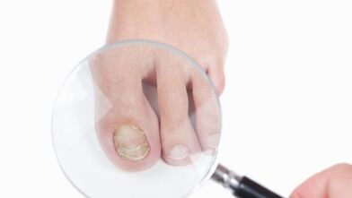 How to treat a fungus on the leg thumb