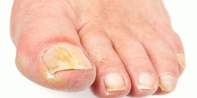 Effective products of nail fungus