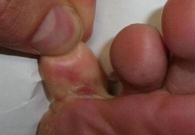 cracked toe due to fungal infection