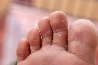 toe fungus symptoms