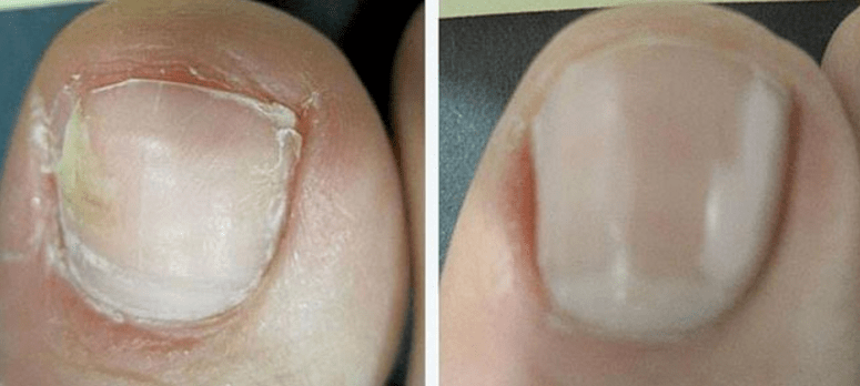 Before and after nail fungus treatment