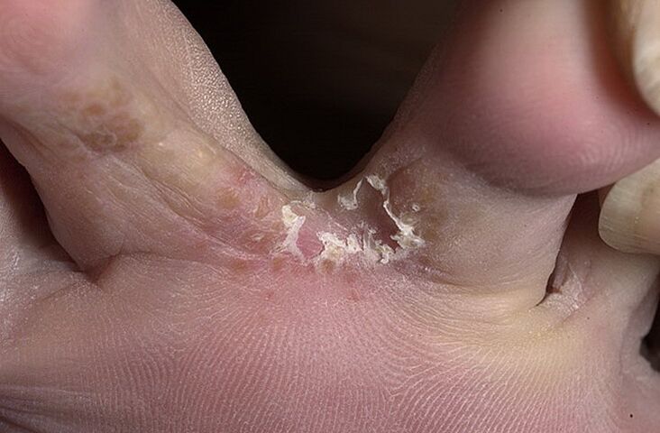 Cracked skin between the toes is a symptom of intertriginal fungus
