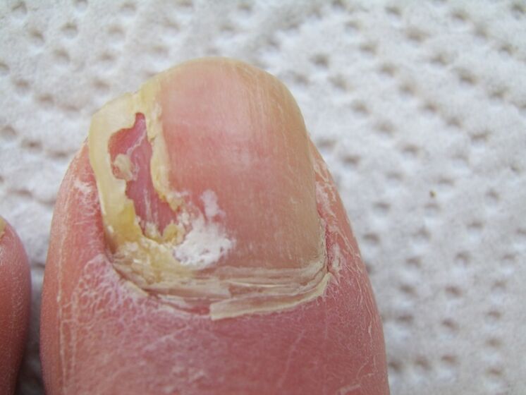 Deformation of the nail plate occurs in the case of onychomycosis