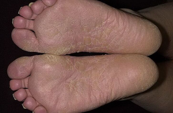 Dry, peeling skin on the feet is a sign of scaly mycosis