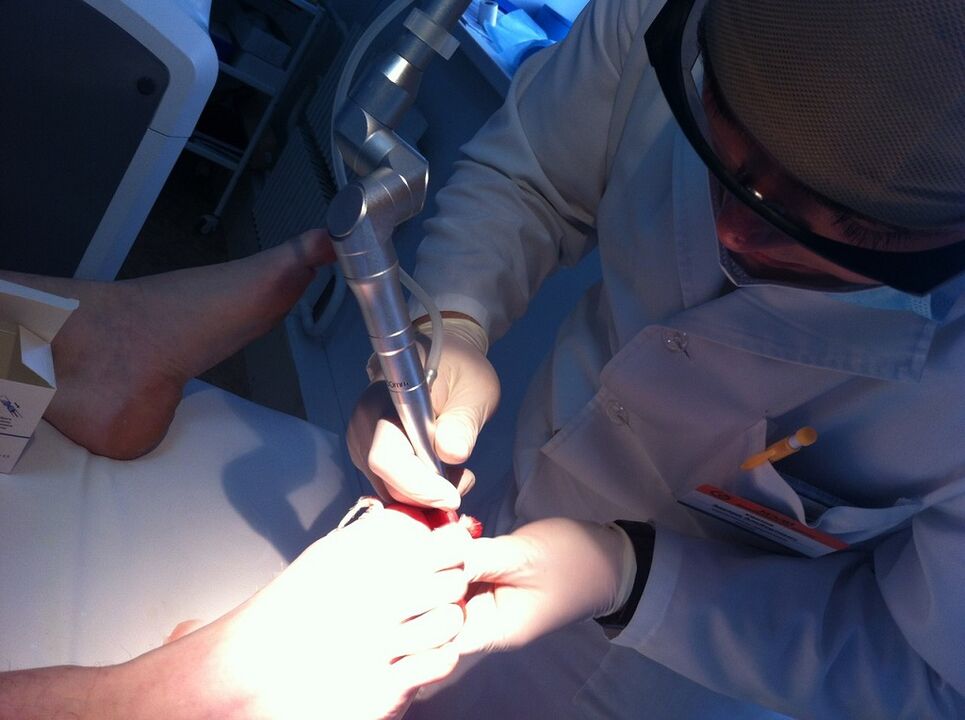Laser treatment of mycosis